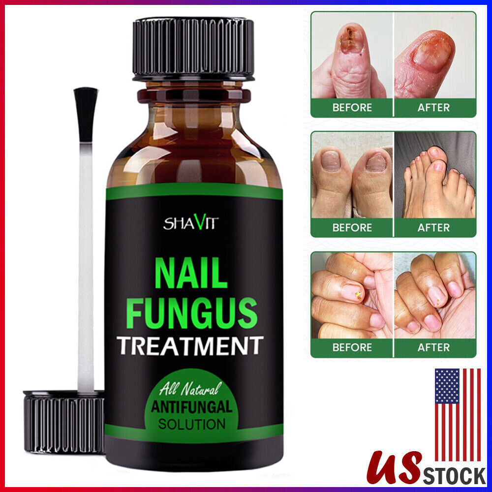 Toenail And Fingernail Fungus Treatment Extra Strength Antifungal Athletes Foot